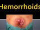 Hemorrhoids Symptoms, Causes And Treatment
